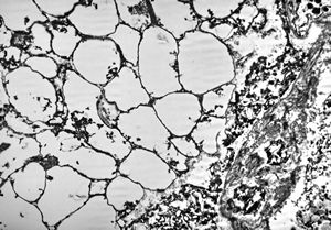 M,50y. | Pneumocystis carinii - lung M,50y. | Pneumocystis carinii - lung